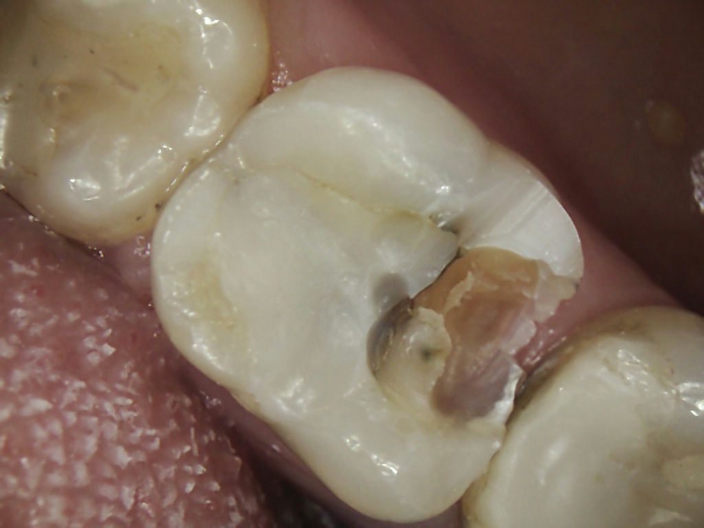 chipped molar no pain